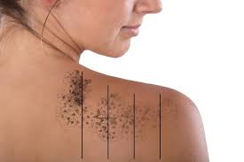 The stages of laser tattoo removal a variety of lasers are available for this purpose. Laser Tattoo Removal An Introductory Guide