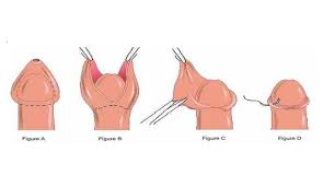 Image result for Phimosis