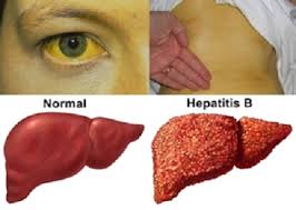 Hati adalah organ terbesar di dalam tubuh dan terletak di sisi kanan perut. Informasi Kesehatan Kenali Penyakit Hepatitis Dinas Kesehatan Kabupaten Agam