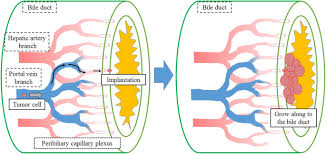 Cancers that have spread are often thought of as advanced when and sometimes, a metastasis may be found before the original (primary) tumor is found. Intrabiliary Growth Type Of Metastasis From Colon Cancer 12 Years After Curative Colectomy A Case Report Bmc Surgery Full Text