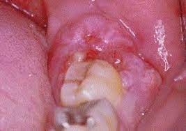 Other conditions, like osteoporosis or arthritis, may also cause bone or joint pain. Oral Osteosarcoma Sciencedirect