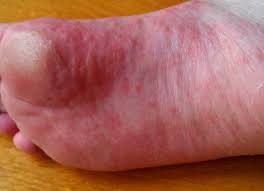 Image result for pompholyx soles of feet
