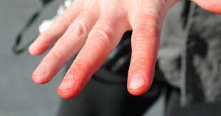 Les symptômes de la douleur au bout des doigts peuvent être très divers. Acrocyanose Tout Savoir Sur Cette Maladie Vasculaire
