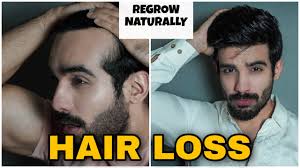 Plus, the vinegar's astringent properties help tighten pores to reduce the amount of oil that is secreted. How To Stop Hair Fall Naturally Regrow Hair Hair Fall Control Dandruff Hair Thinning Men Women Youtube