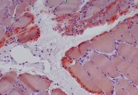 Amyloid fibers muscle fiber pathology in amyloidosis. Amyloid Pathology