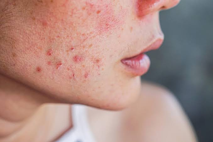 Acne Scars Treatment in Dubai | Laser Treatment for Acne Removal