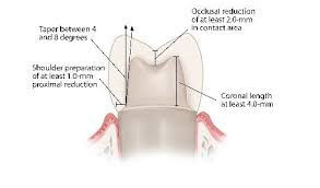 Image Result For Molar Pfm Crown Prep Dental Crown