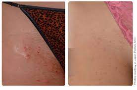 He or she may prescribe medicine, such as an antibiotic. Laser Hair Removal Greeley Hair Removal Co Facial Hair Removal 80634 Northern Colorado Laser Skin