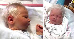 It has broken out in the burn. Boy Is Born With Snow White Hair When Doctors Tells His Mom The Truth She S Speechless