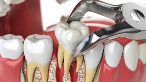Image result for Tooth Extraction