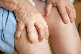 Image result for gout symptoms knee