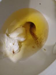 Coffee ground discharge early pregnancy. Coffee Grounds Discharge Babycenter