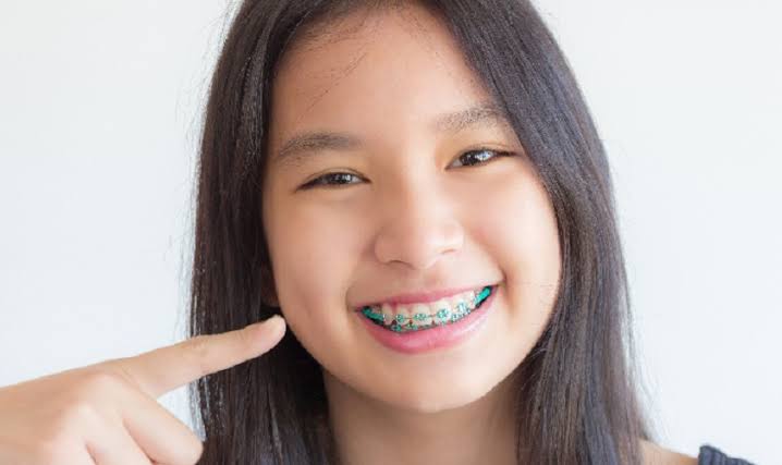 các trường hợp niềng răng