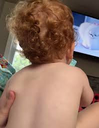 Image result for HAIR Score