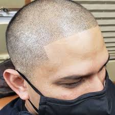 Baldness is the most common among 50% of all men, who are older than 50 years. Hair Tattoo Process Cost Side Effects Of Bald Scalp Tattoo
