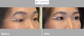 If you are asian, you may have one of several types of eyelid creases or you can have 2 different types, one for each eyelid. Asian Blepharoplasty And Eyelid Crease Surgery Photos Mehryar Ray Taban Md