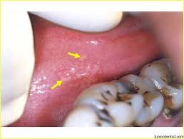 Follow the home remedies and. Fordyce Granules Fordyce Spots