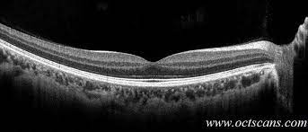 Optical Coherence Tomography Scans Optical Coherence Tomography Eye Wear Glasses Optometry