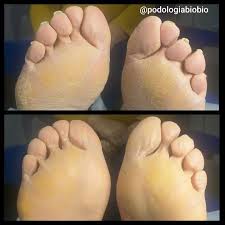 Image result for Anhidrosis