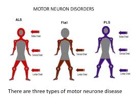 Pin On Encephalomalacia Mnd