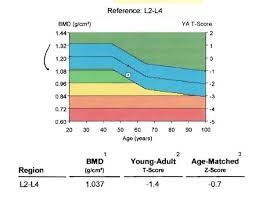 osteopenia osteoporosis basic science orthobullets