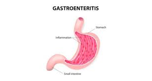 People usually call it a stomach bug or stomach flu, even though it's not limited to just influenza. Gastroenteritis Health Tips Gastroenteritis Health Articles Health News Thehealthsite Com