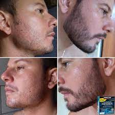 Never saw any results using it this way. 20 Best Minoxidil Ideas Minoxidil Hair Regrowth Treatments Help Regrow Hair