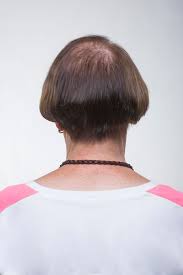 Haarausfall Bei Frauen Stoppen