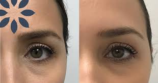 The forehead lift is done using sutures to preferentially lift the outer eyebrows. Botox Brow Lift Treatment Before After Photos 1073666