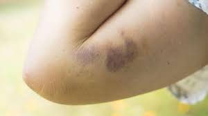 Nisu bezazlene: 7 uzroka modrica, a nisu udarci | Express