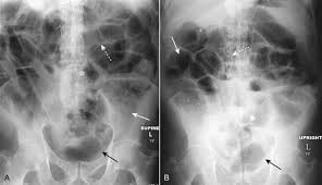 Image result for Adynamic Ileus