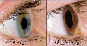 تحدب القرنية اسباب و علاج القرنية المخروطية تداووا