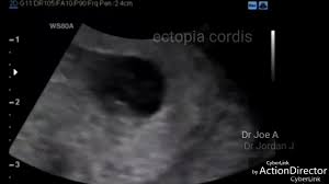 A Gallery Of High Resolution Ultrasound Color Doppler 3d Images Fetal Heart 275 x 236 png 46 кб. fetal heart