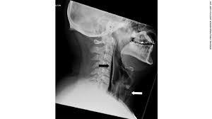 Here S Why You Should Never Hold In A Sneeze Sneezing Stop Sneezing Throat