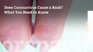 Most infected people will develop mild to. Does Coronavirus Cause A Rash What You Need To Know Health Com