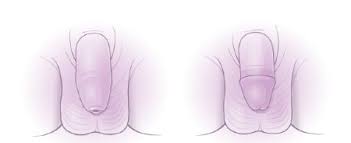 Image result for Neonatal Circumcision