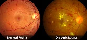 We have expertise in nearly every eye condition including diabetic eye disease, glaucoma, macular degeneration, retinal diseases, cataracts, and corneal disease. Diabetic Retinopathy Symptoms Causes Treatment Surgery How To Relief