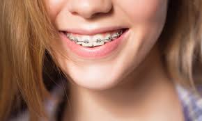 There are many people who are unaware they need braces at all until the dentist/orthodontist says something. All About Braces In Alpharetta Newpark Orthodontics