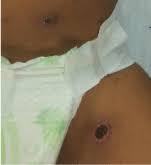 Eschara) is a slough or piece of dead tissue that is cast off from the surface of the skin, particularly after a burn injury, but also seen in gangrene, ulcer, fungal infections, necrotizing spider bite wounds, tick bites associated with spotted fevers, and exposure to cutaneous anthrax. Eschar A Key To Diagnose Scrub Typhus