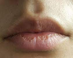 Skin Concerns] Unsure Of What To Do About Constant Dry Peeling Lips :  R/Skincareaddiction
