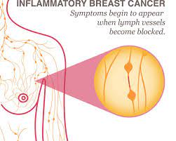 Inflammatory breast cancer causes are the same as other types of breast cancer. Inflammatory Breast Cancer Symptoms Diagnosis Treatment National Breast Cancer Foundation