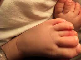 It was so tight, her toe had begun to turn purple. another shared that in their medical clinic, a kid came in with a hair tourniquet of the penis, which can happen when a hair gets caught in a baby's diaper. Hair Tourniquet Mum S Warning To Parents After Hair Gets Wrapped Round Baby S Toe Teesside Live