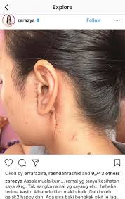 Telefilem isteriku ms sally full janna nick, hafreez adam. Zara Zya Tunjuk Parut Lepas Bedah Media Hiburan