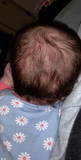 (1) the struggle to keep my appearance there were countless stories of women losing a lot of hair after having their babies, but nothing about losing it during pregnancy. Baby Losing Hair Help Please August 2018 Babies Forums What To Expect
