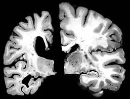 The most common early symptom of alzheimer's is trouble remembering new information because the disease typically impacts the part of the brain associated with learning first. Warum Alzheimer Immer Noch Unheilbar Ist