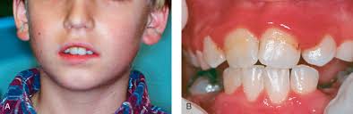 It is an infection caused by germs called bacteria. Gingivitis An Overview Sciencedirect Topics