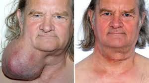 Ian Crow, from Ashby, lived with HUGE tumour