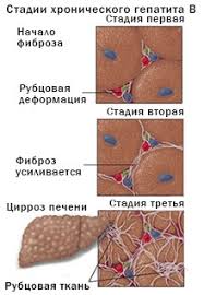 Lechenie Hronicheskogo Gepatita B B Gastroenterologicheskij Centr Ekspert S Peterburg