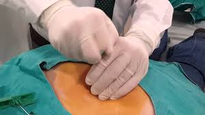 Ct Guided Bone Biopsy Youtube