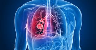 Although the percentage of cases in men is much lower than in women, male breast cancer accounts for a por. Cancer Du Poumon Sites D Interet Et Groupes De Soutien